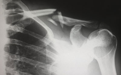 Post Surgical Rehabilitation